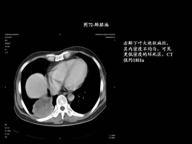 常见肺部CT病例读片