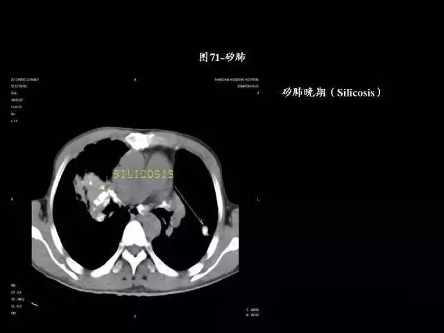常见肺部CT病例读片
