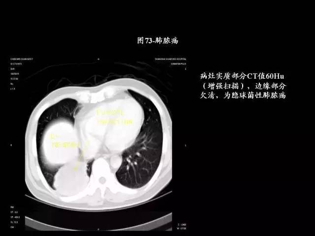 常见肺部CT病例读片