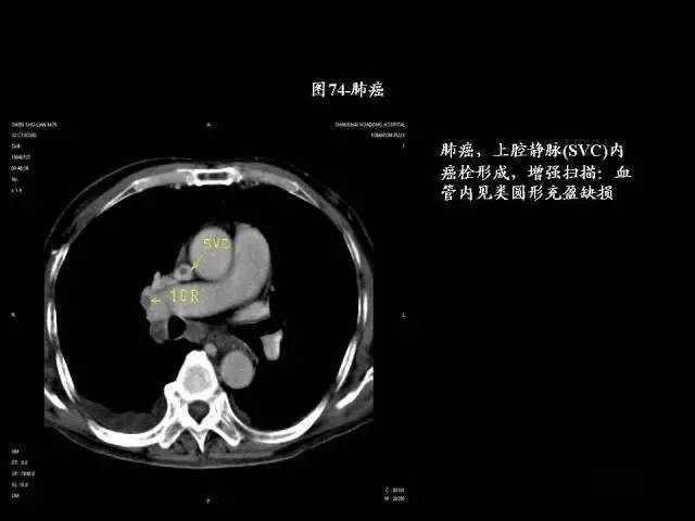 常见肺部CT病例读片