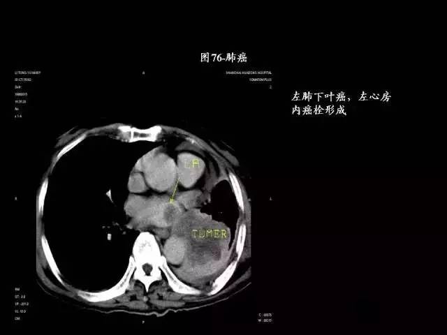 常见肺部CT病例读片