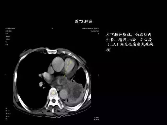 常见肺部CT病例读片