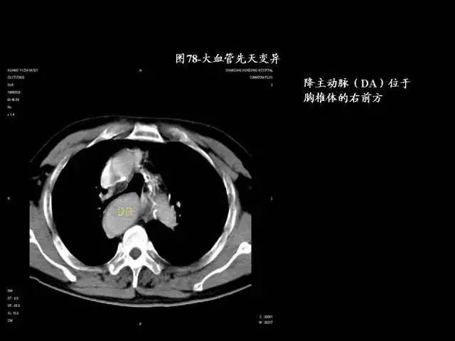 常见肺部CT病例读片
