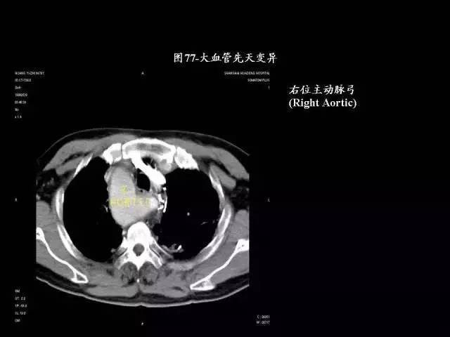 常见肺部CT病例读片
