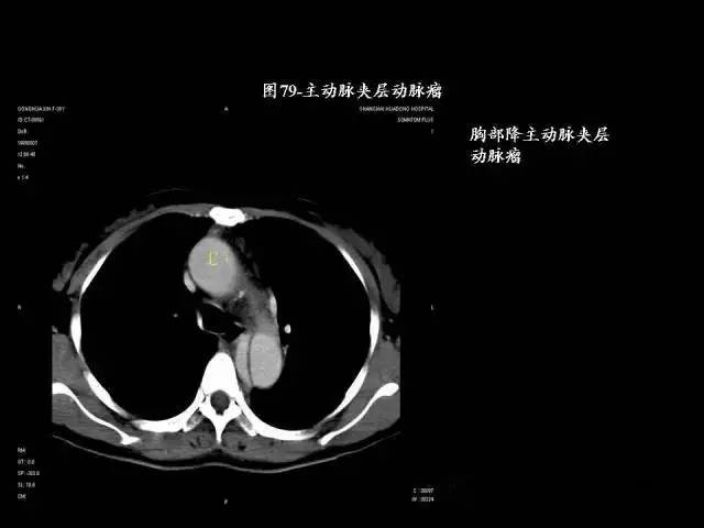 常见肺部CT病例读片