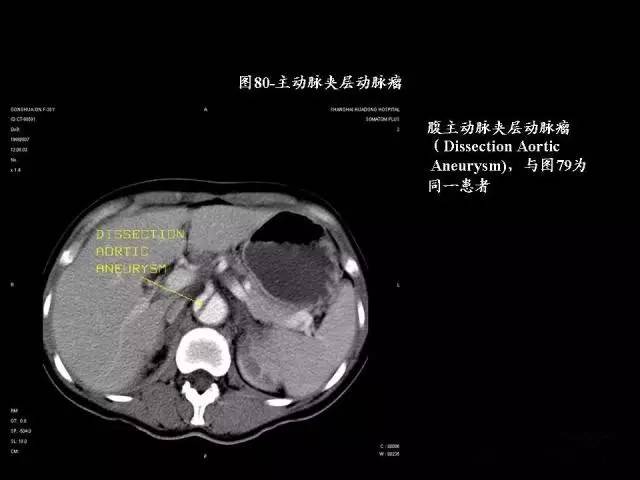 常见肺部CT病例读片