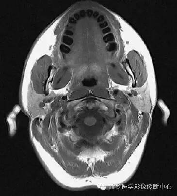 颈部精细横断位解剖+详细标注