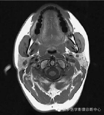 颈部精细横断位解剖+详细标注