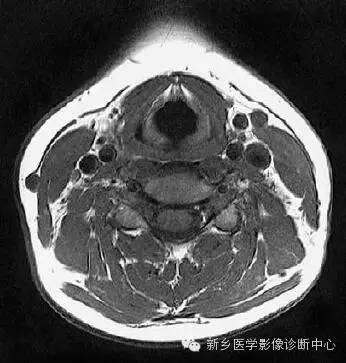 颈部精细横断位解剖+详细标注