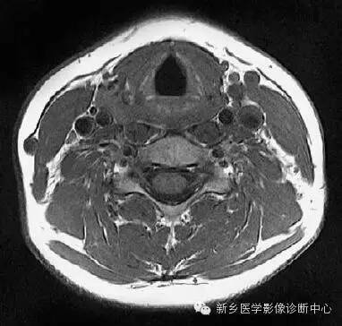 颈部精细横断位解剖+详细标注