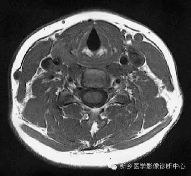 颈部精细横断位解剖+详细标注