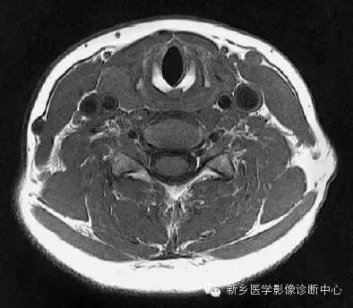 颈部精细横断位解剖+详细标注
