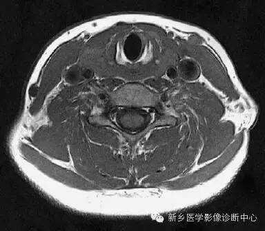 颈部精细横断位解剖+详细标注