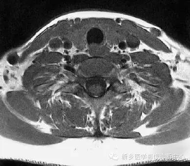颈部精细横断位解剖+详细标注