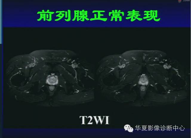 DWI序列之：在前列腺癌中的应用