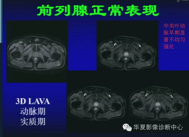 DWI序列之：在前列腺癌中的应用