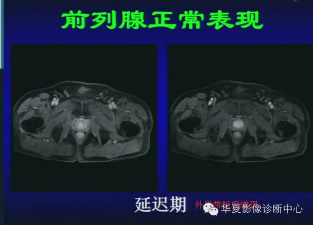 DWI序列之：在前列腺癌中的应用
