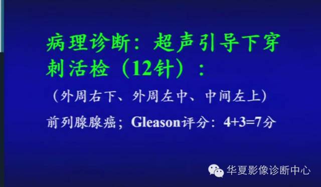 DWI序列之：在前列腺癌中的应用