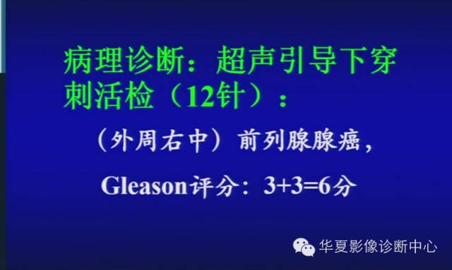 DWI序列之：在前列腺癌中的应用