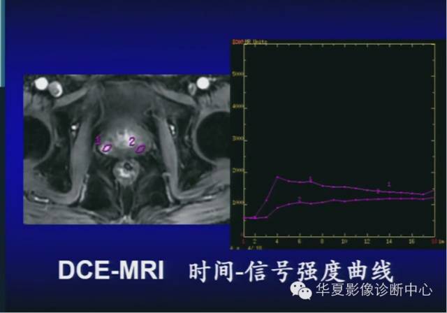 DWI序列之：在前列腺癌中的应用