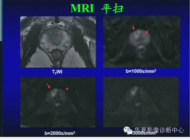DWI序列之：在前列腺癌中的应用