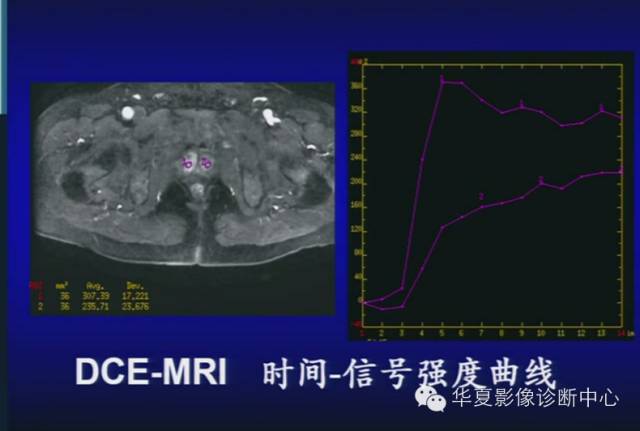 DWI序列之：在前列腺癌中的应用