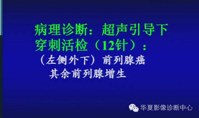 DWI序列之：在前列腺癌中的应用