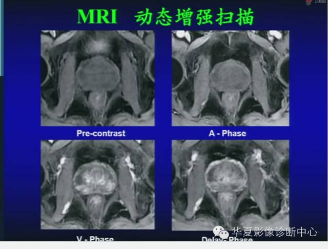 DWI序列之：在前列腺癌中的应用