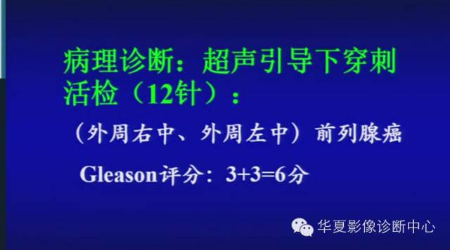 DWI序列之：在前列腺癌中的应用