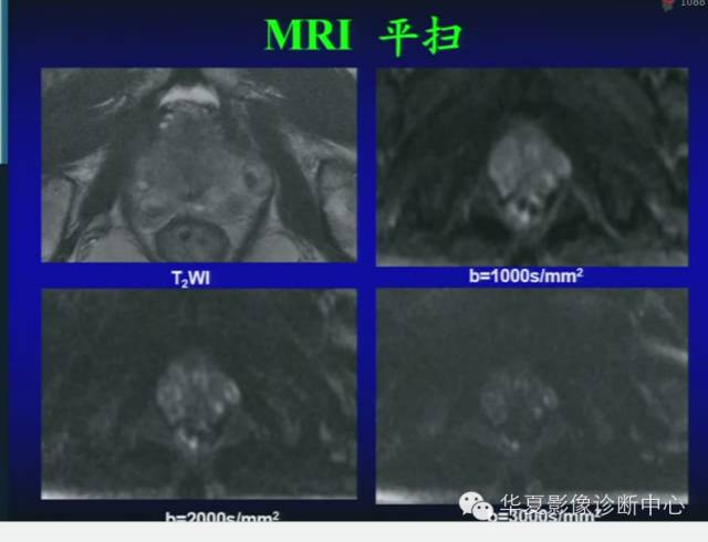 DWI序列之：在前列腺癌中的应用