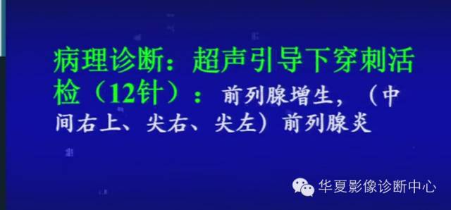 DWI序列之：在前列腺癌中的应用