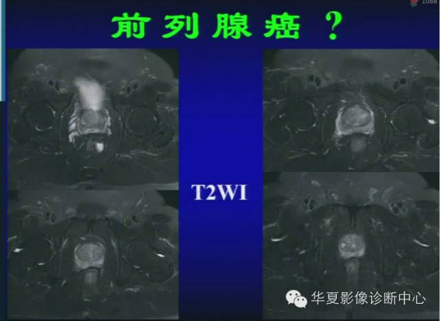 DWI序列之：在前列腺癌中的应用