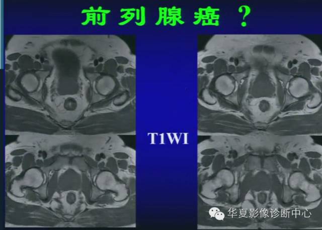 DWI序列之：在前列腺癌中的应用