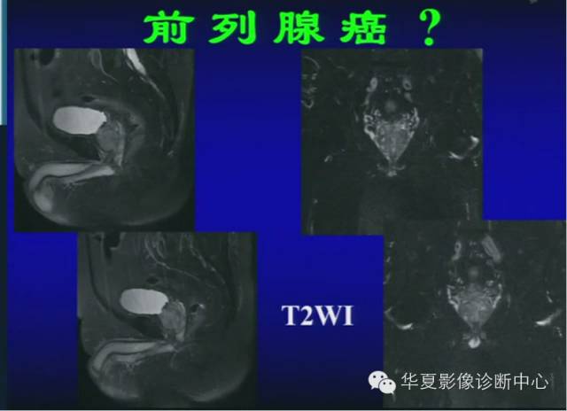 DWI序列之：在前列腺癌中的应用