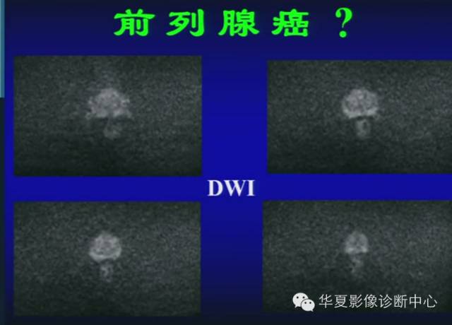 DWI序列之：在前列腺癌中的应用