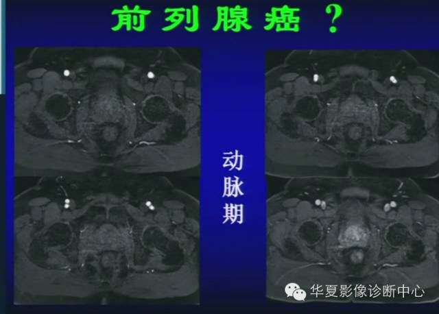 DWI序列之：在前列腺癌中的应用