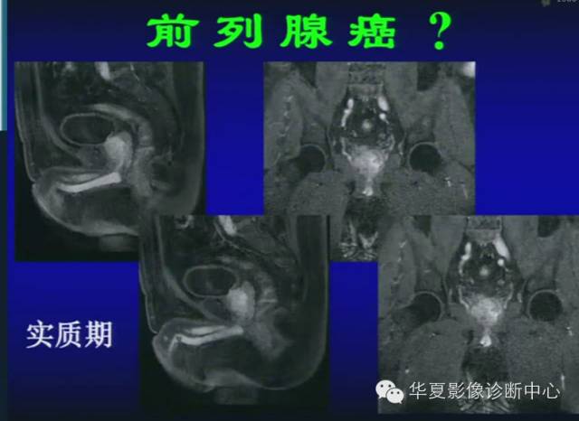 DWI序列之：在前列腺癌中的应用