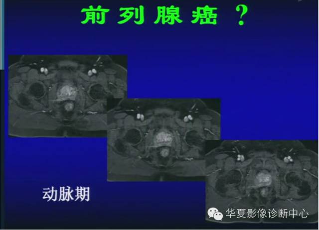 DWI序列之：在前列腺癌中的应用