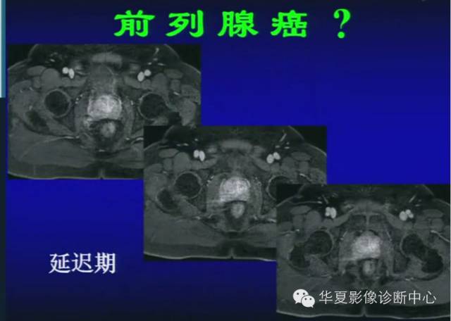 DWI序列之：在前列腺癌中的应用