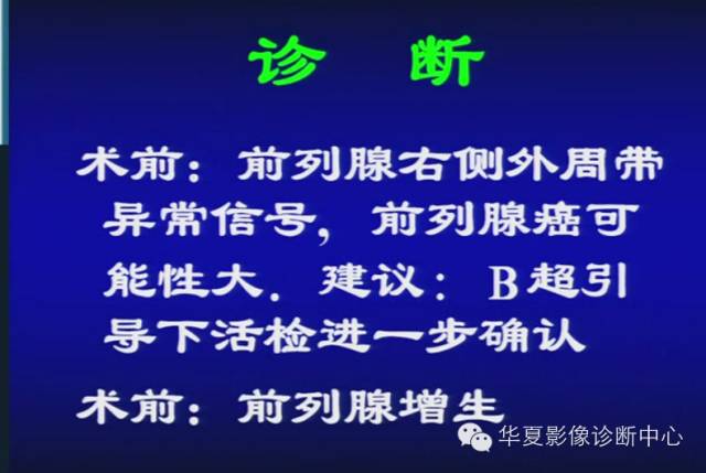 DWI序列之：在前列腺癌中的应用