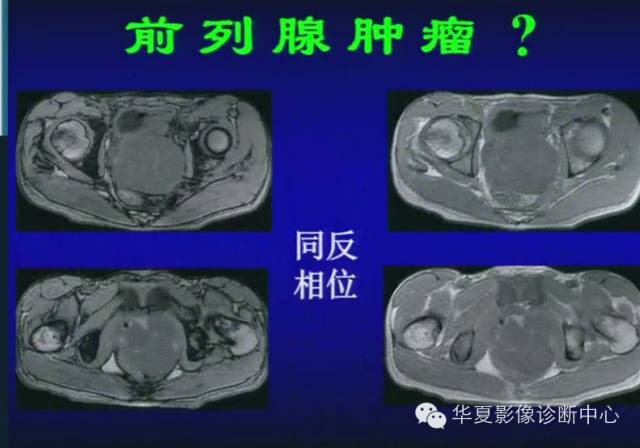 DWI序列之：在前列腺癌中的应用