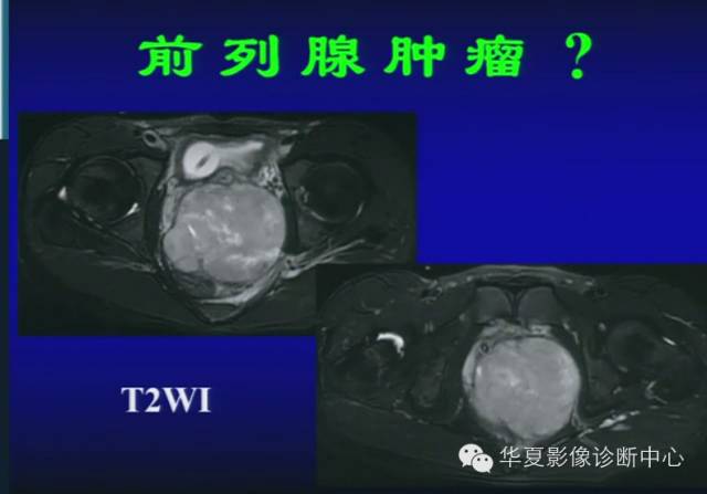 DWI序列之：在前列腺癌中的应用