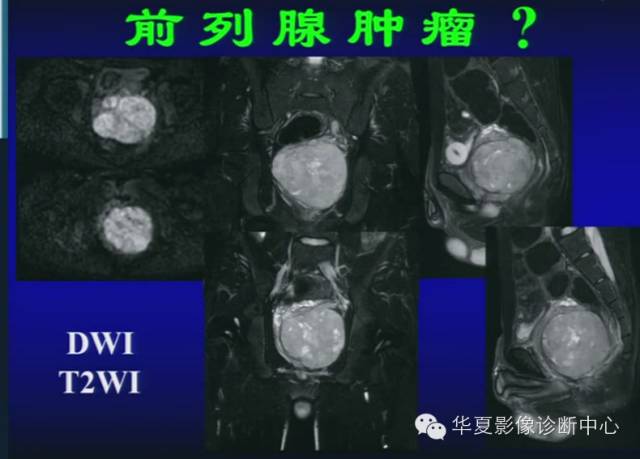 DWI序列之：在前列腺癌中的应用