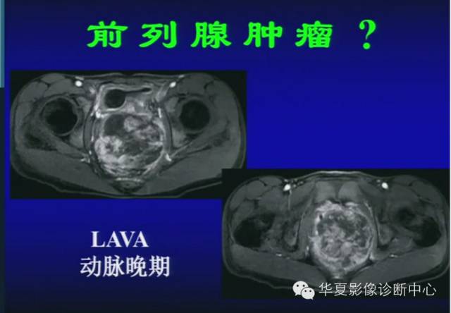 DWI序列之：在前列腺癌中的应用