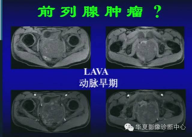 DWI序列之：在前列腺癌中的应用