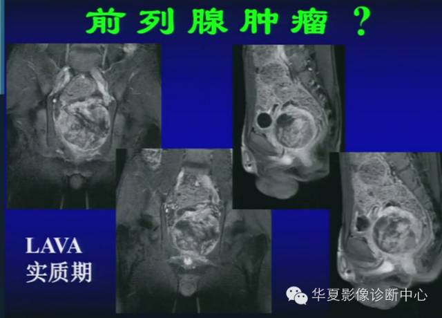 DWI序列之：在前列腺癌中的应用