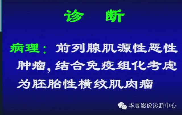 DWI序列之：在前列腺癌中的应用