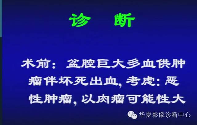 DWI序列之：在前列腺癌中的应用