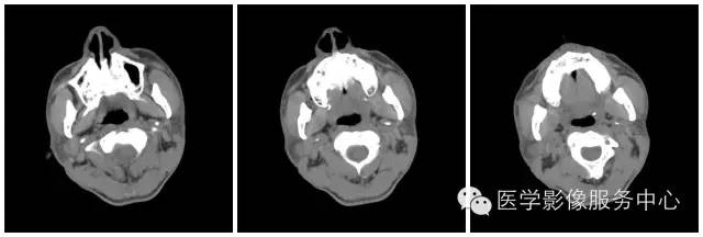 【病例】腮腺腺淋巴瘤1例CT影像表现