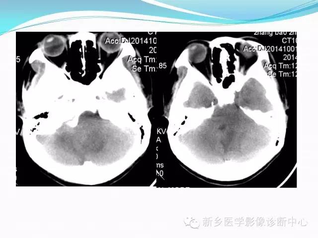 【病例】成人小脑髓母细胞瘤1例影像表现